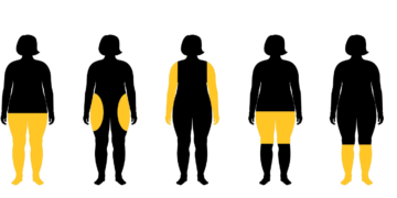 Tratamiento de Fisioterapia en el Lipedema: Mejora tu Calidad de Vida
